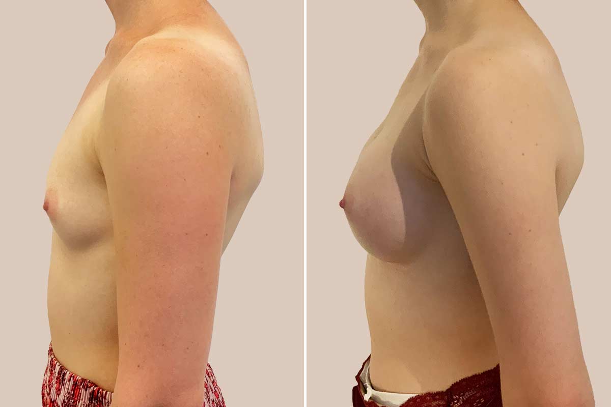 Brystforstørrelse Motiva Ergonomix