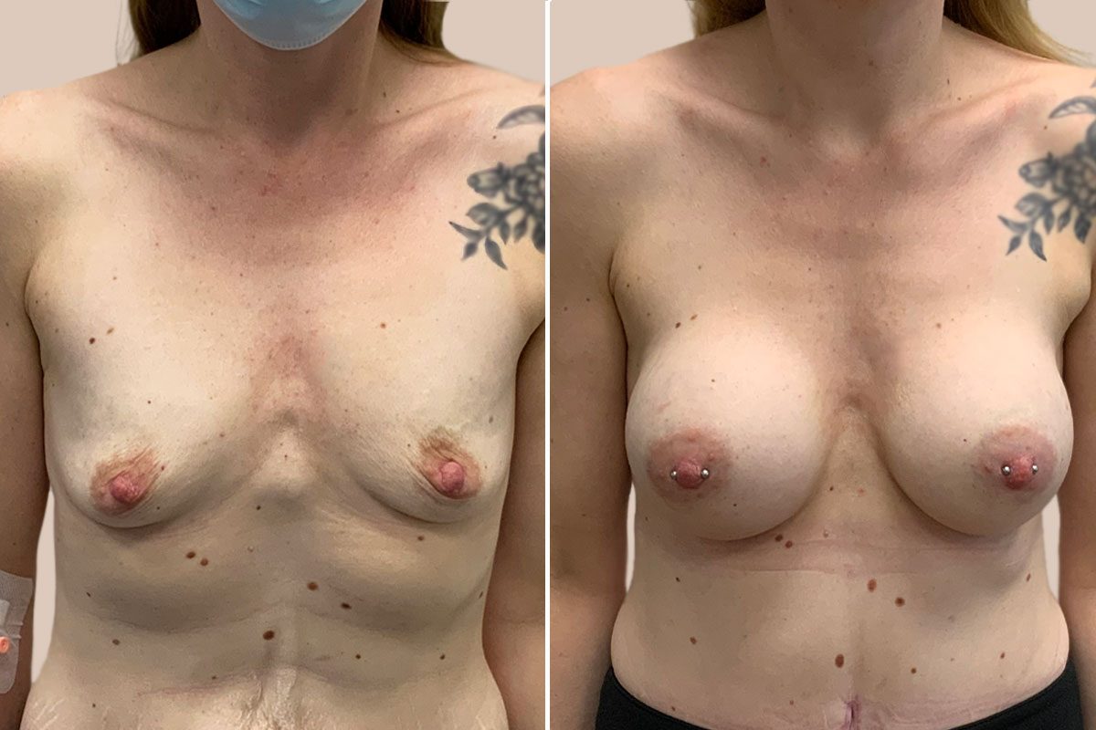 Brystforstørrelse før og efter