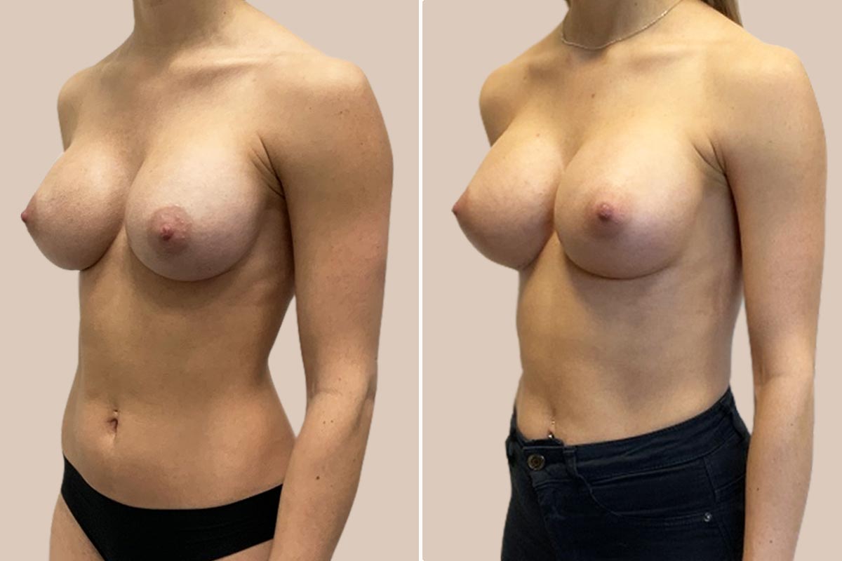 Udskiftning af implantater