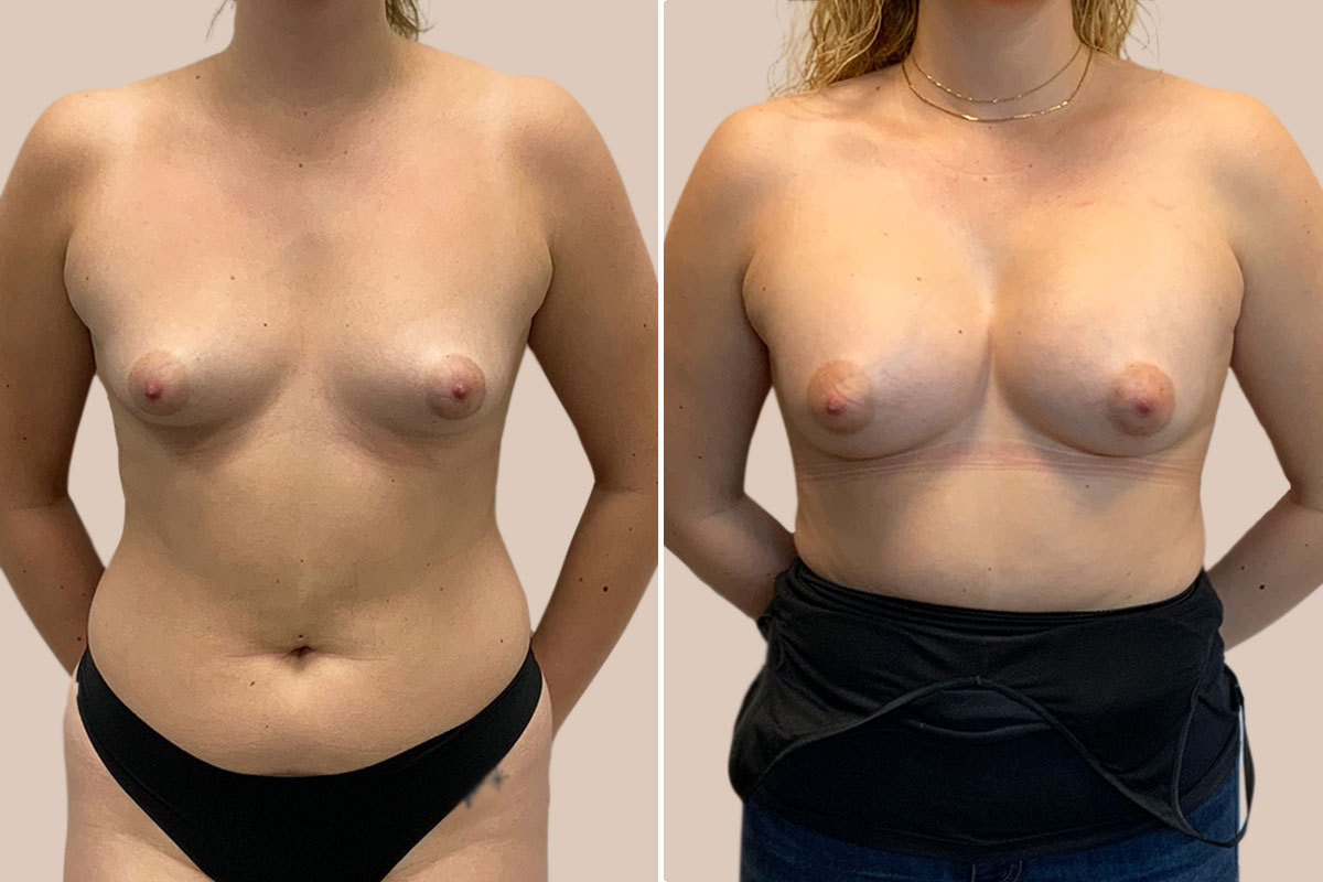 bfo før og efter billeder