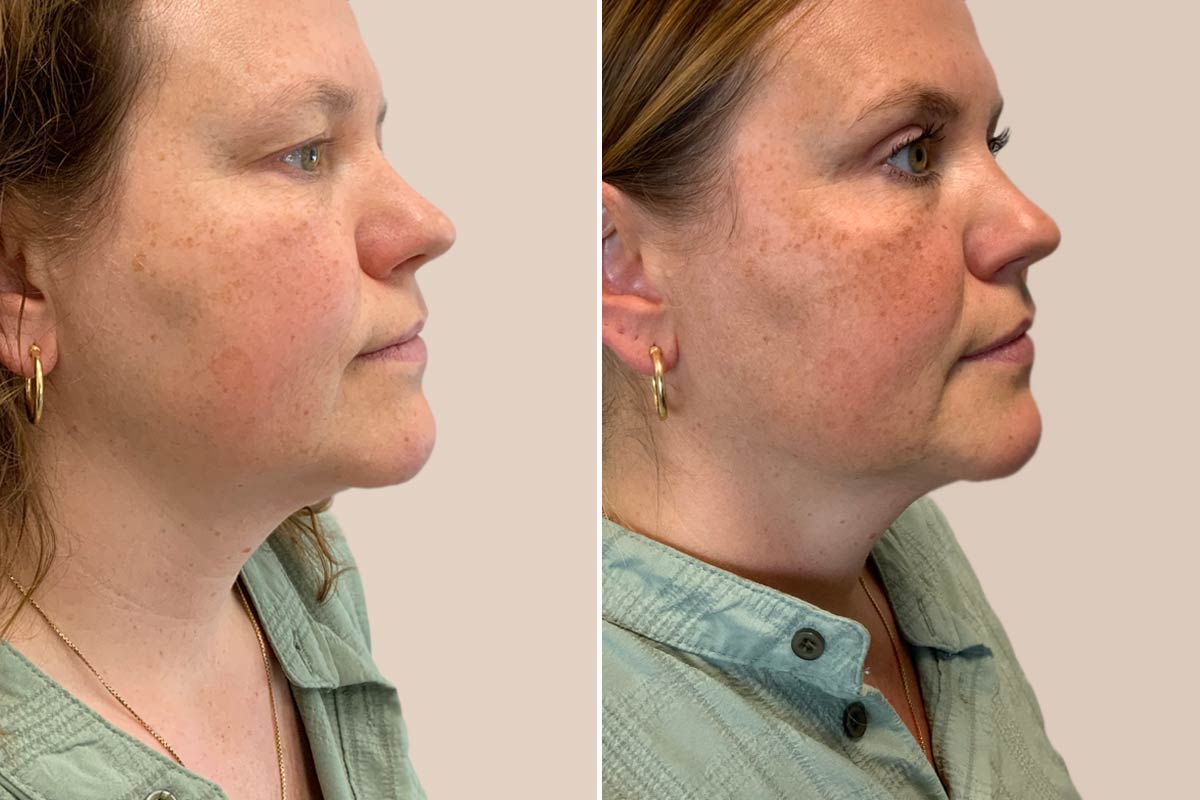 Øjenlågsoperation før og efter