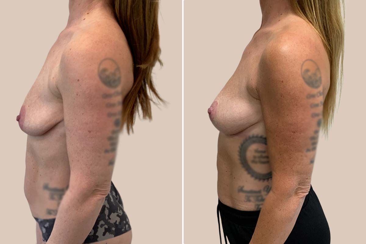 Brystøft før og efter