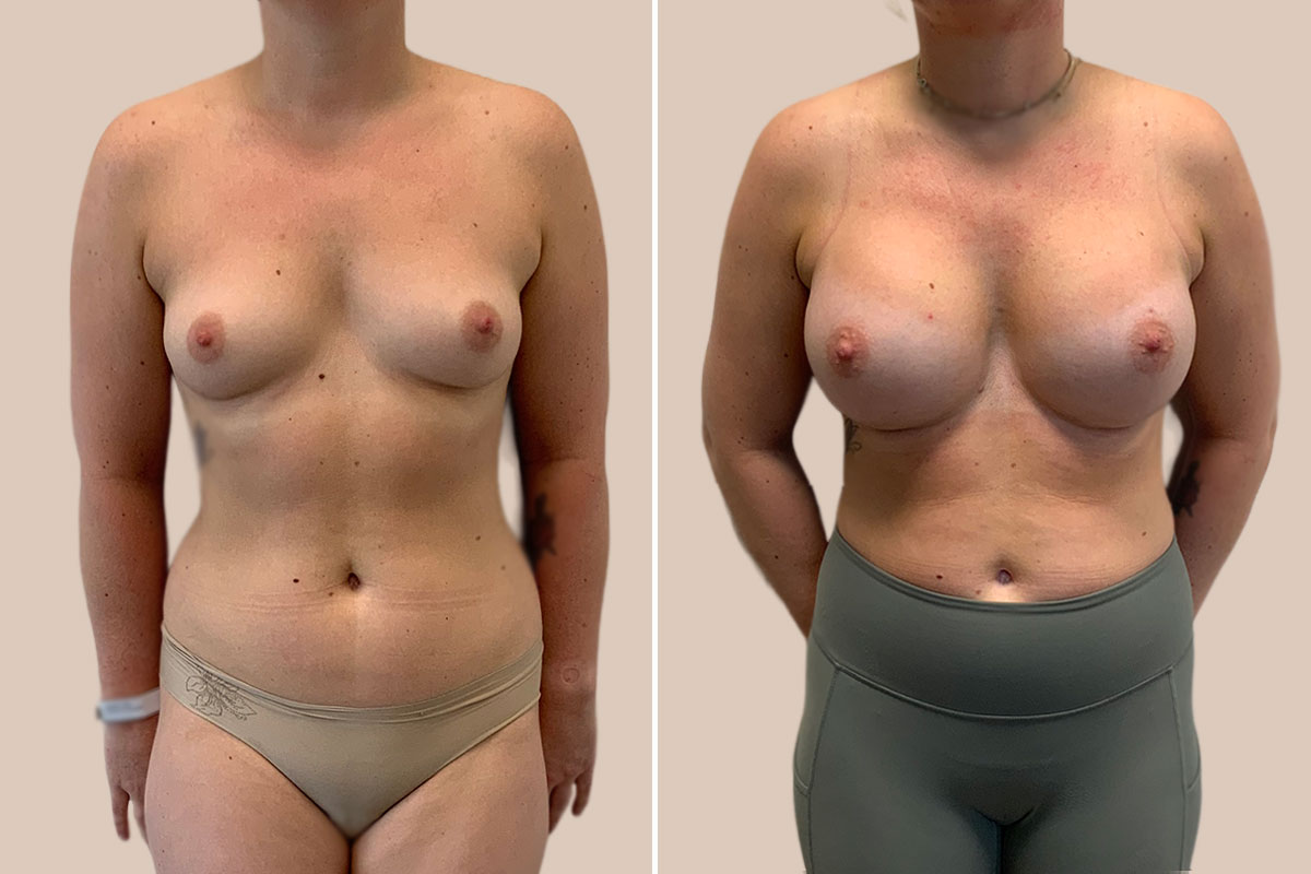 Brystforstørrelse før og efter