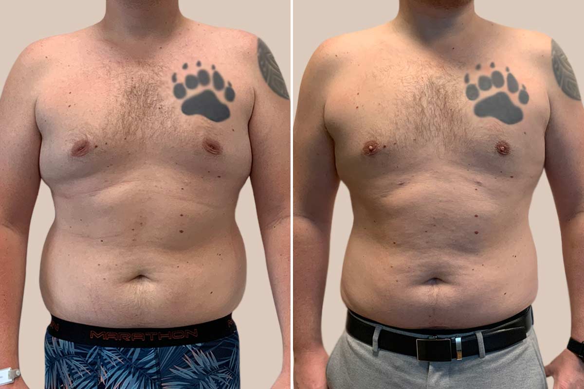 Fedtsugning af brystkasse og dansehåndtag