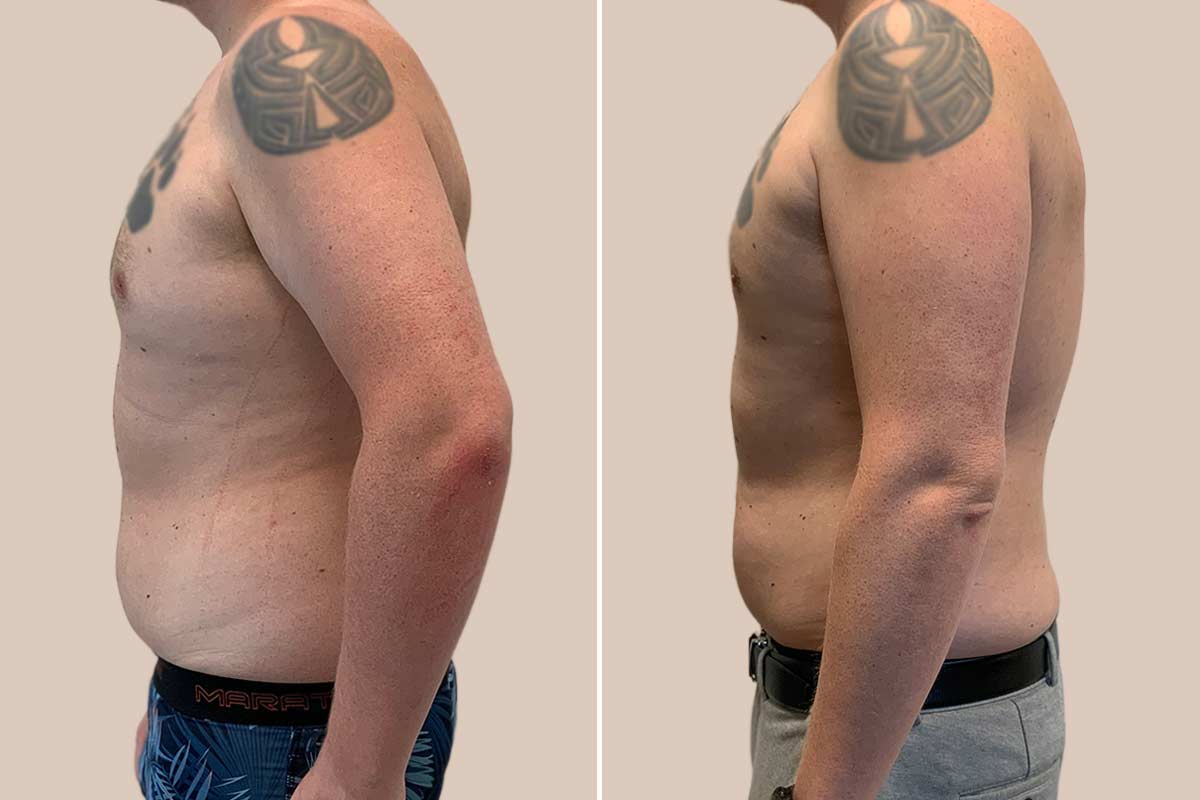 Fedtsugning af brystkasse og dansehåndtag