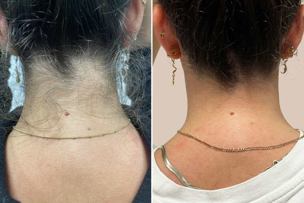 Laser hårfjernelse af nakken - 1 behandling.