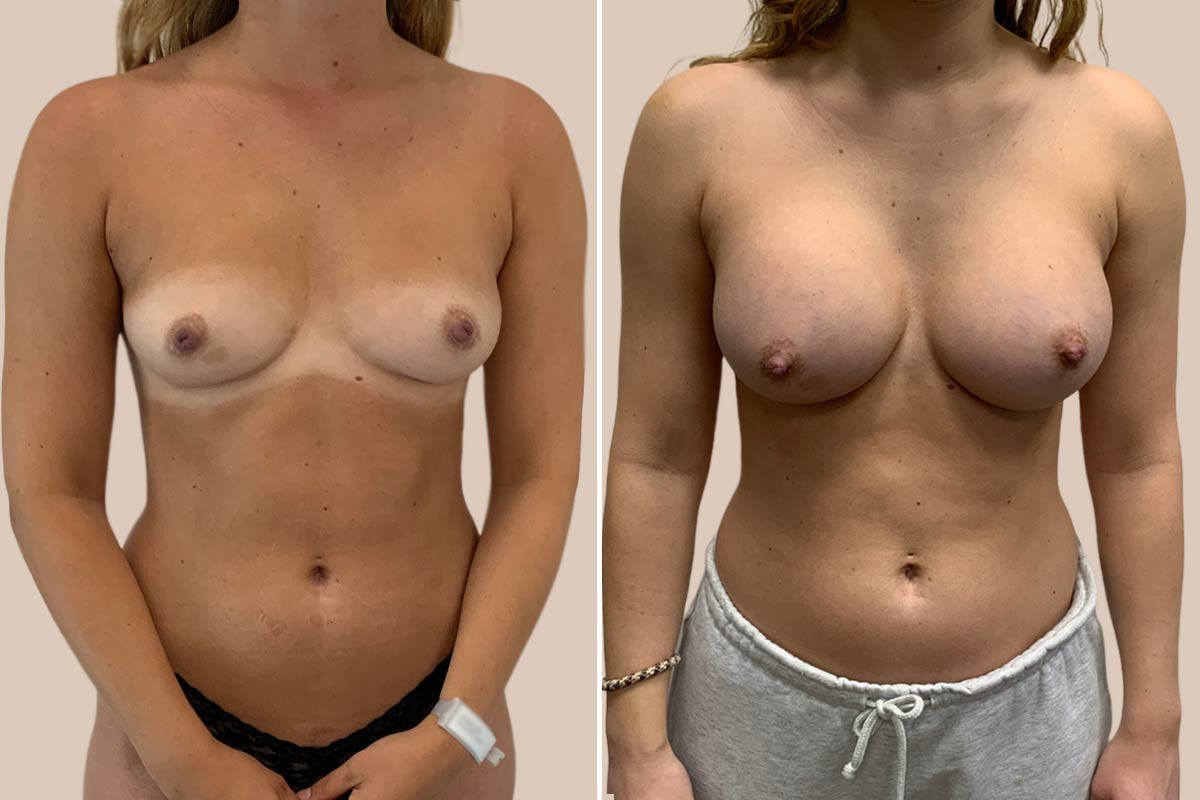 Brystforstørrelse før og efter