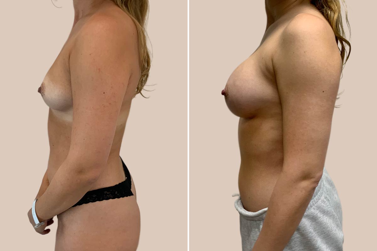 Brystforstørrelse før og efter