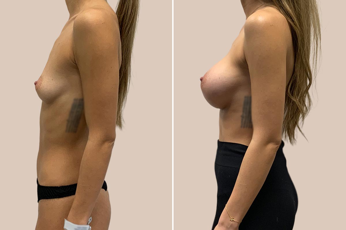 Brystforstørrelse Motiva Ergonomix