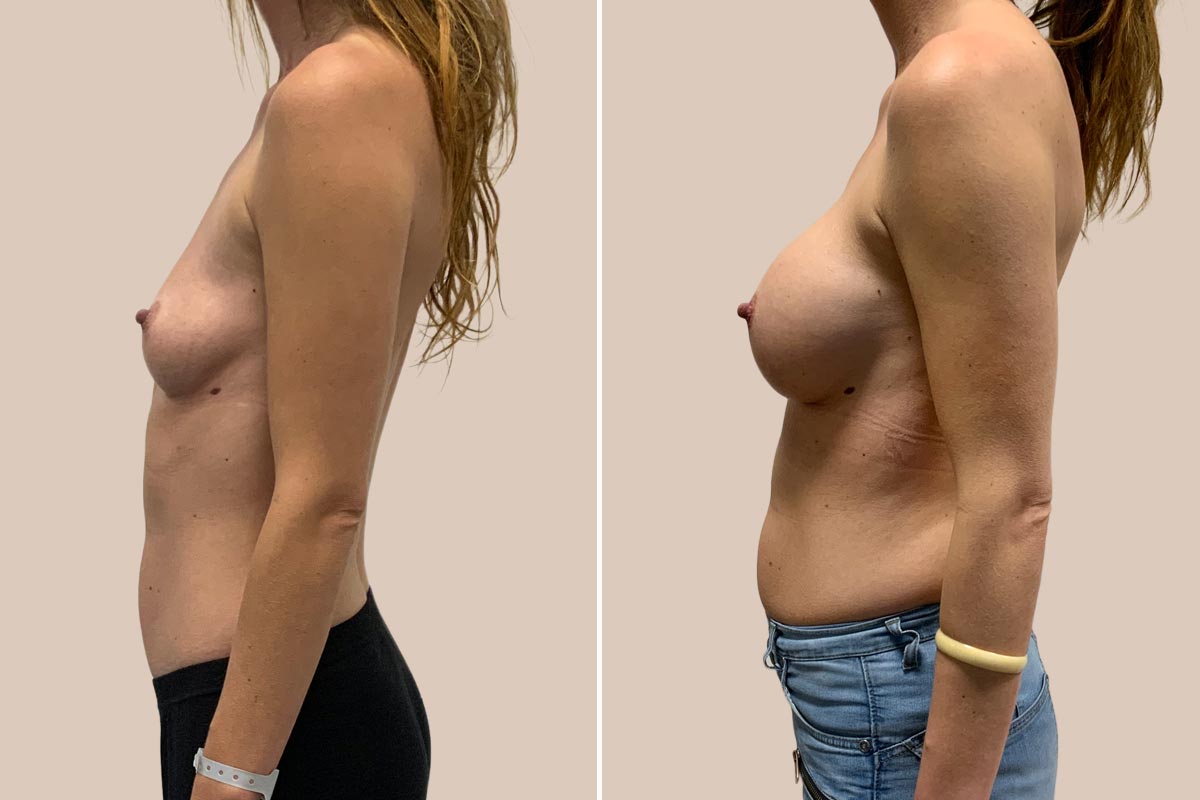 Brystforstørrelse Motiva Ergonomix