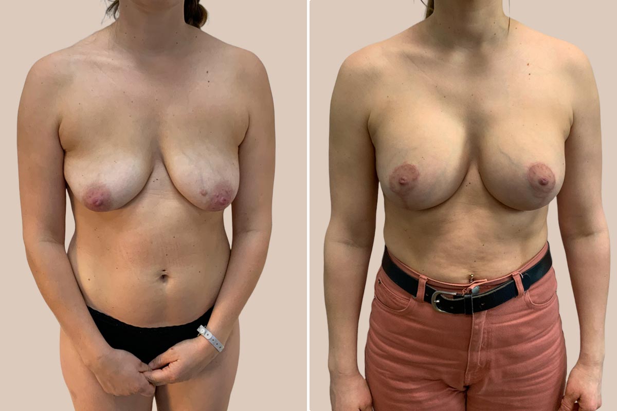 BFO og stort brystløft