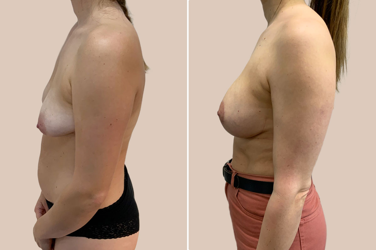 BFO og stort brystløft