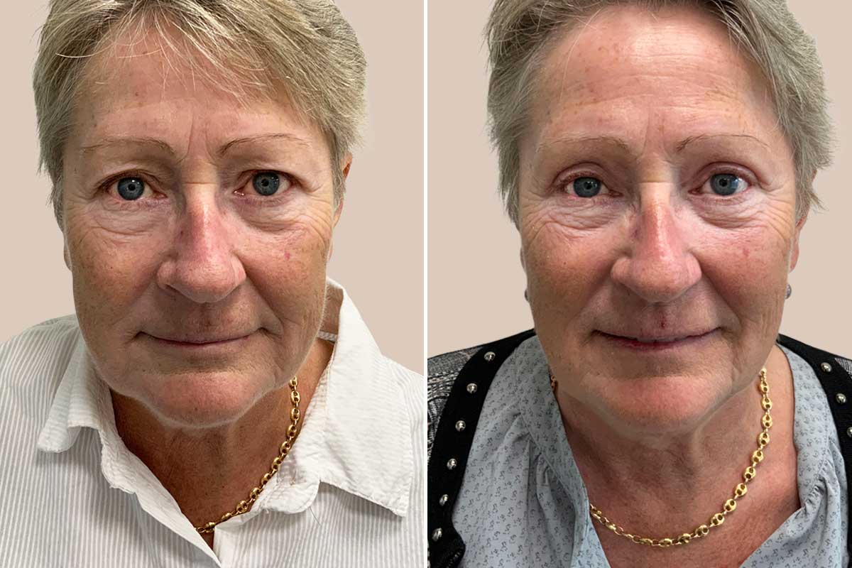 Øvre øjenlågsoperation