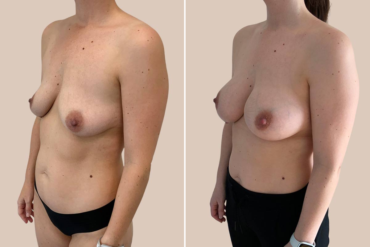 Brystforstørrelse med Motiva Ergonomix