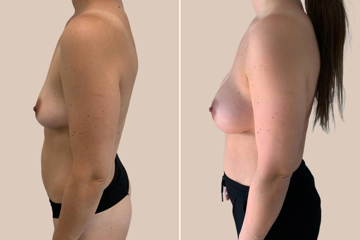 Brystforstørrelse Motiva Ergonomix