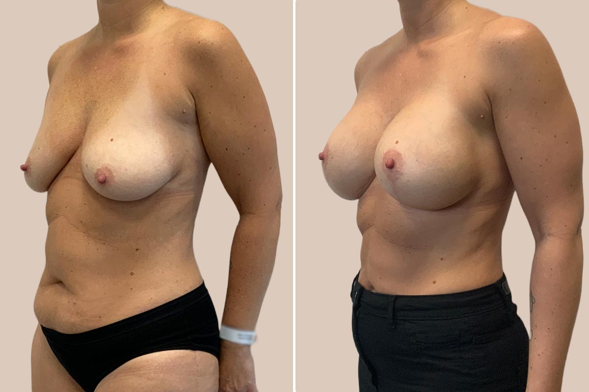 Brystforstørrelse og stort løft