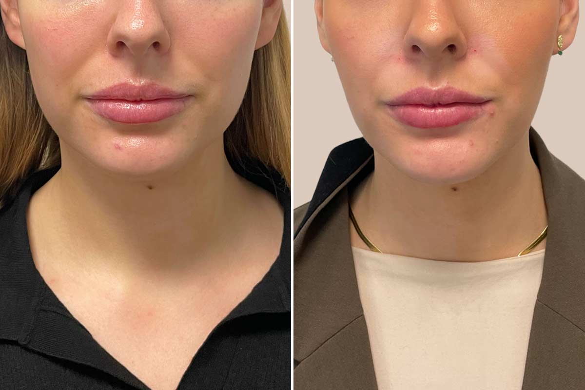 Botox - masseter / tyggemuskel