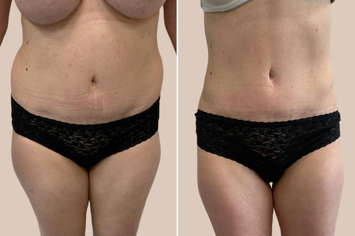 Fedtsugning af nedre ryg