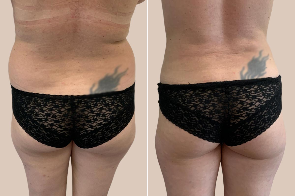 Fedtsugning af nedre ryg