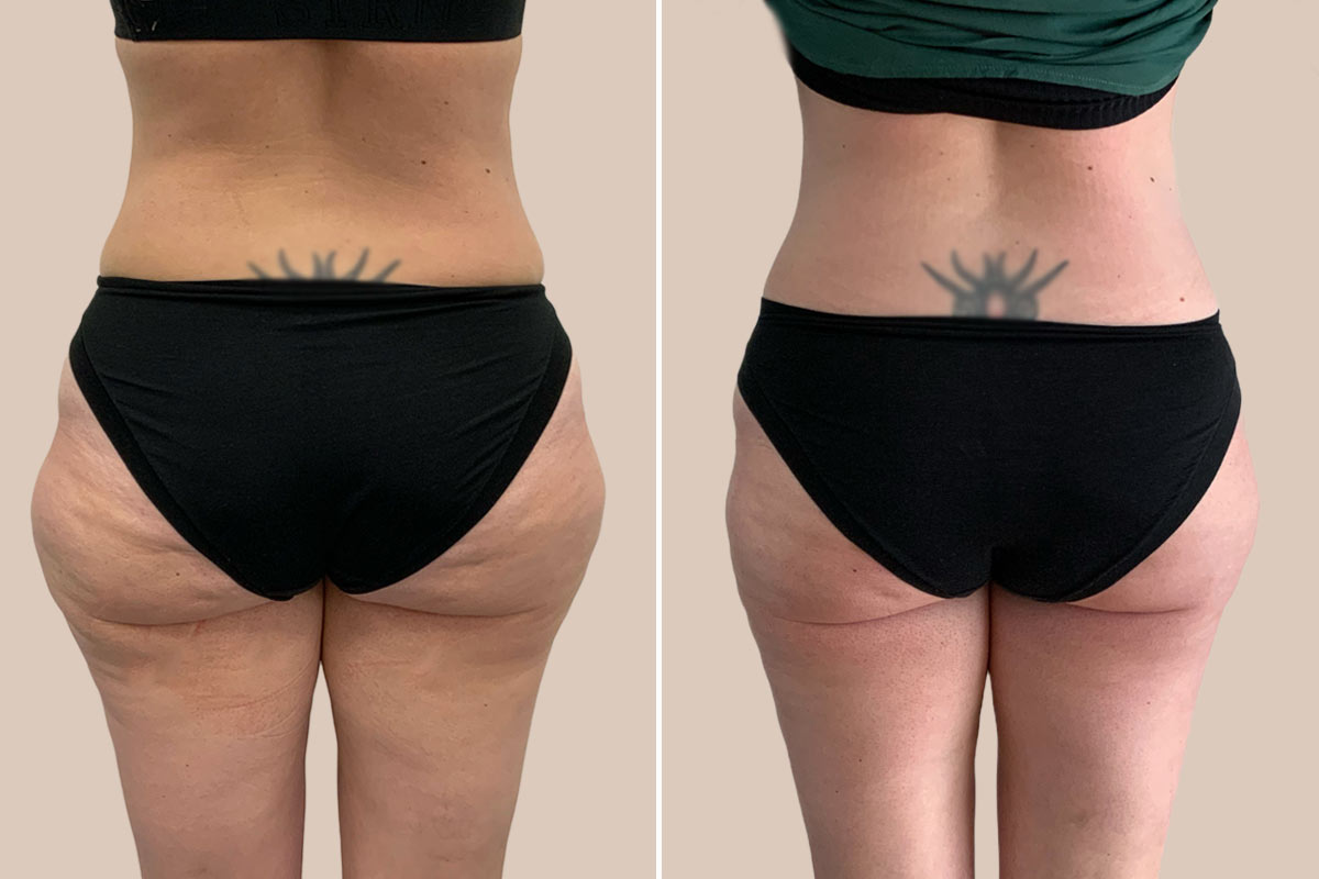 Fedtsugning af yderlår