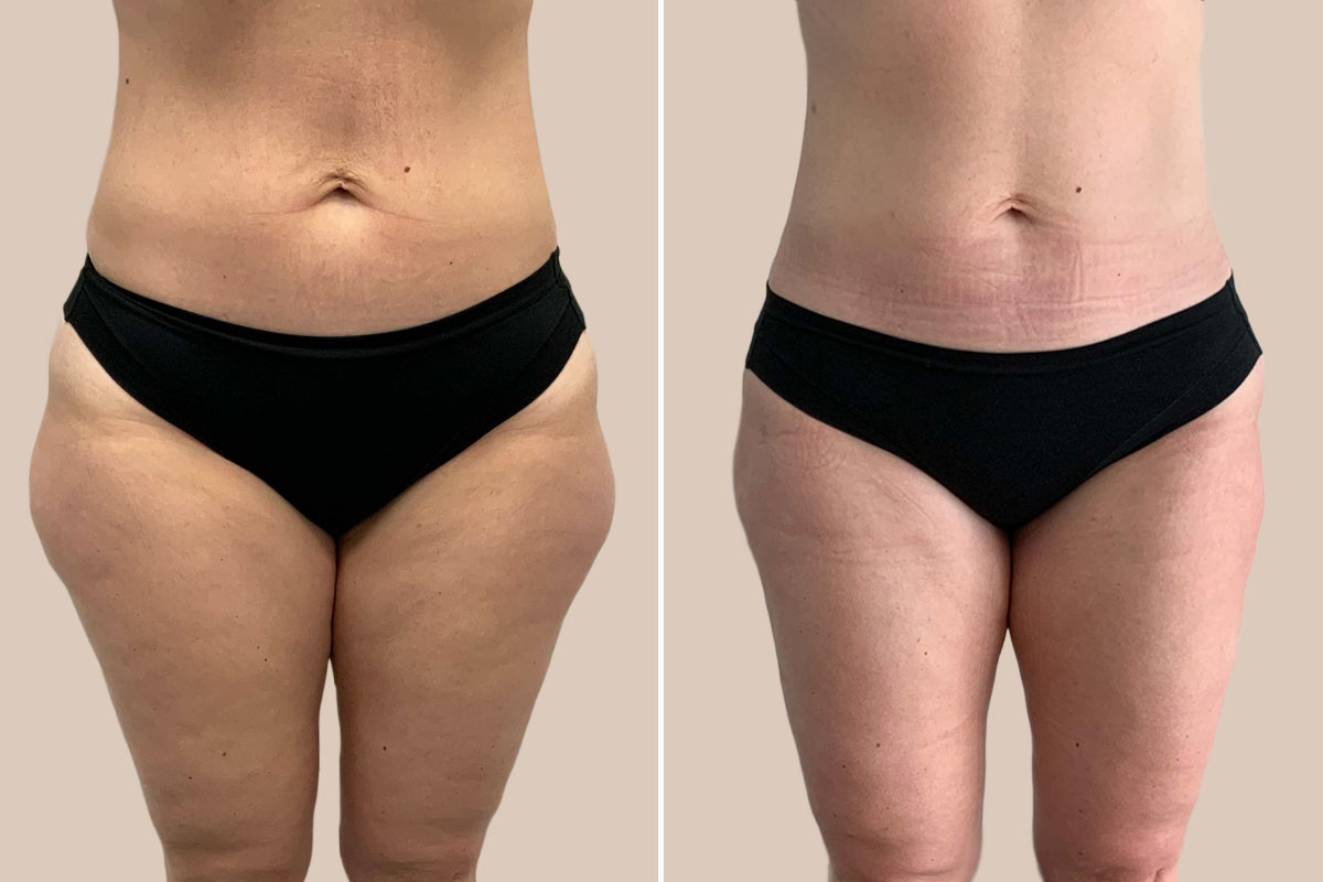 Fedtsugning af yderlår