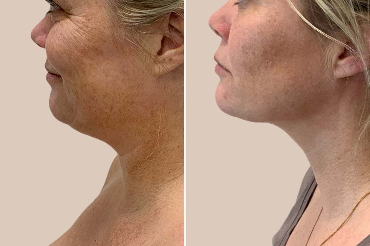 Fedtsugning af hage og hals