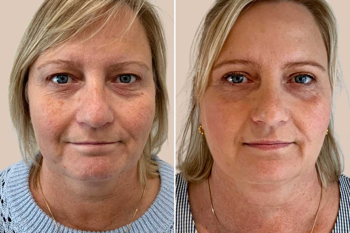 Øvre øjenlågsoperation