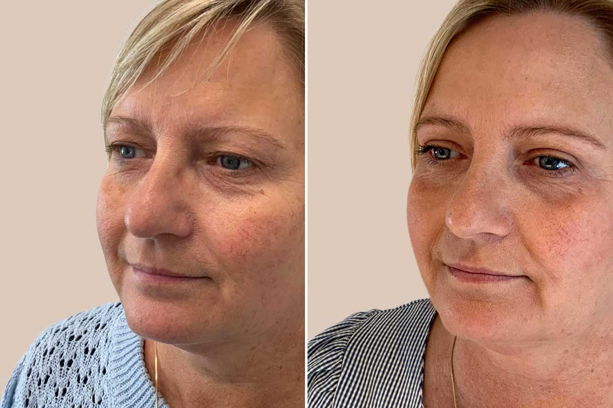 Øvre øjenlågsoperation