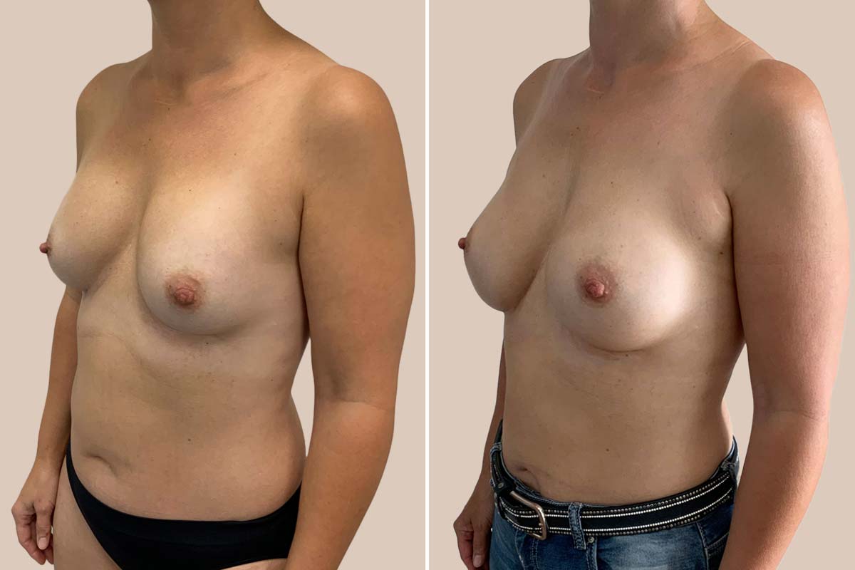 Udskiftning af implantater