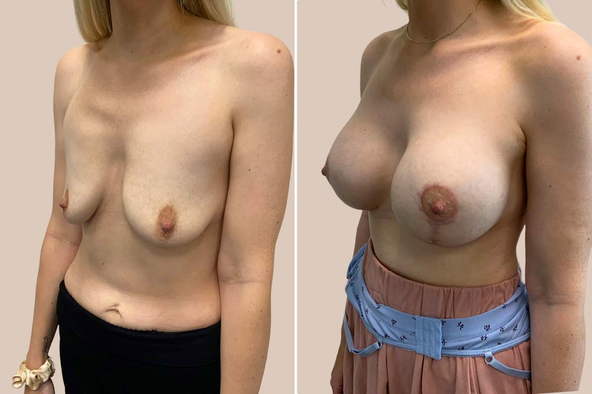 Brystforstørrelse og stort løft