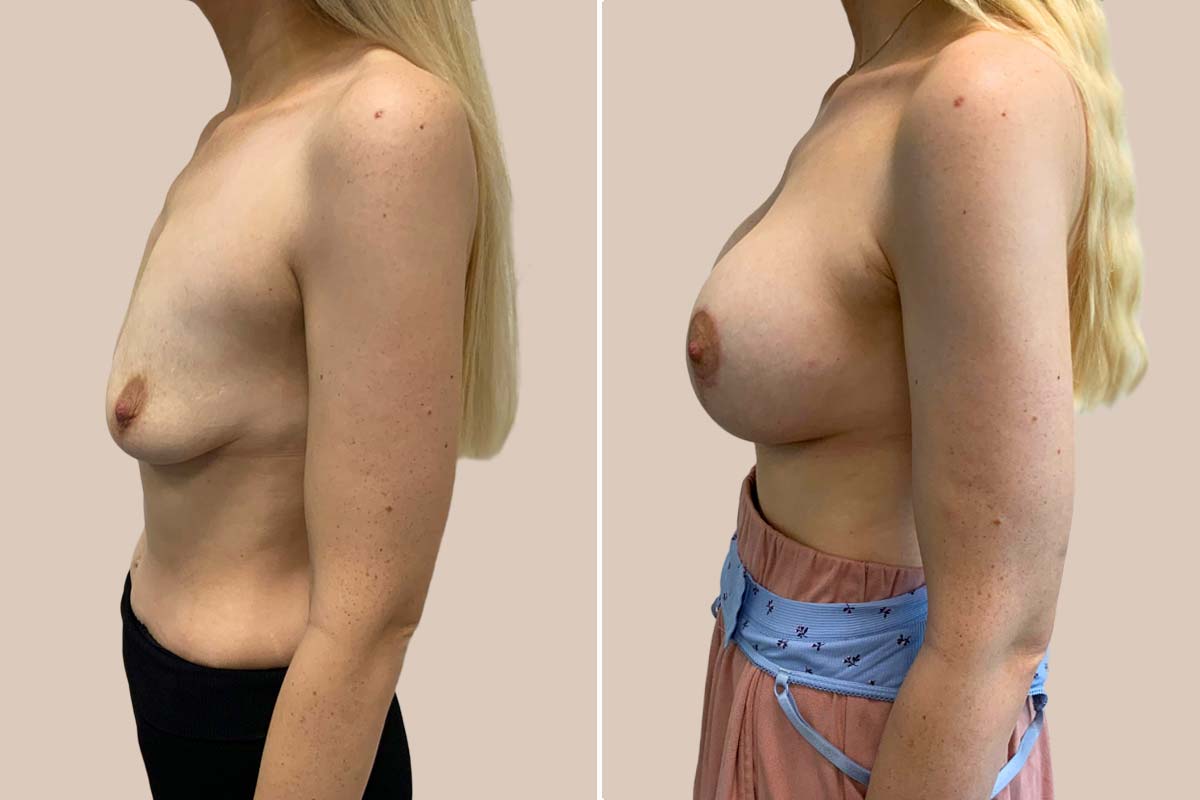 Brystforstørrelse og løft