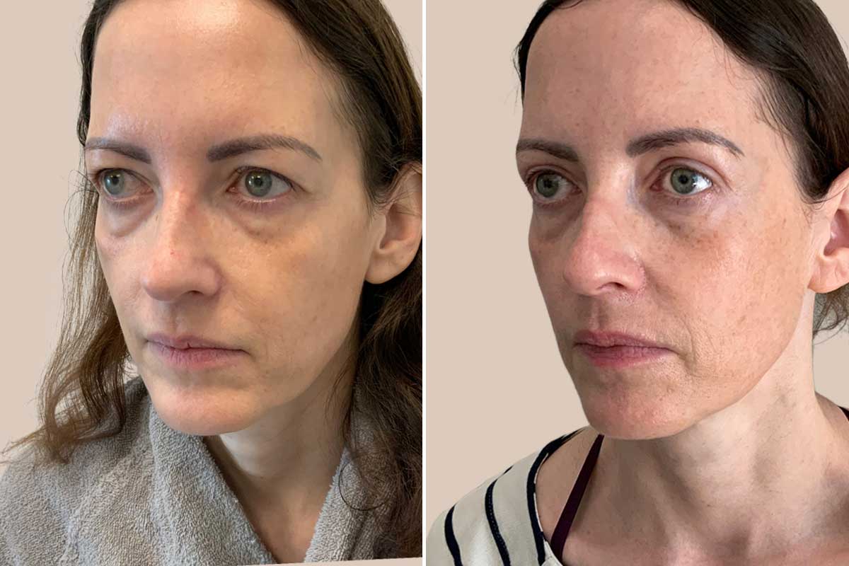 Øvre øjenlågsoperation