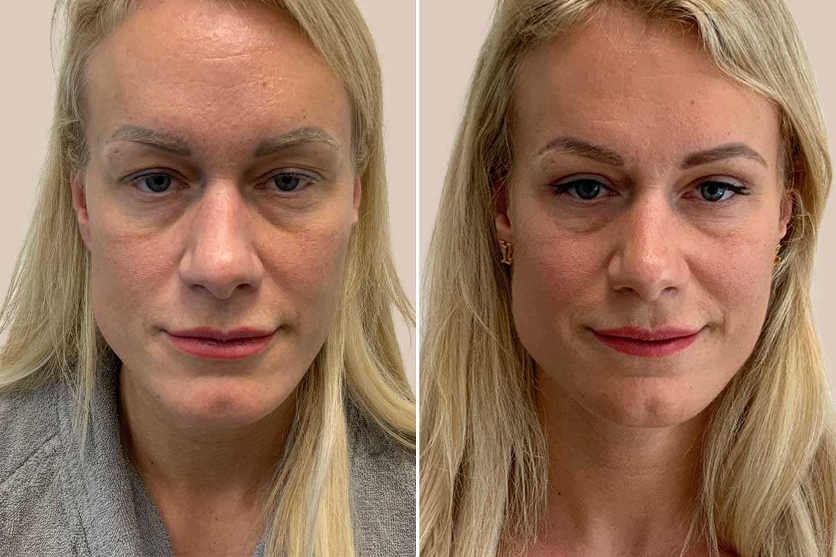 Øvre øjenlågsoperation