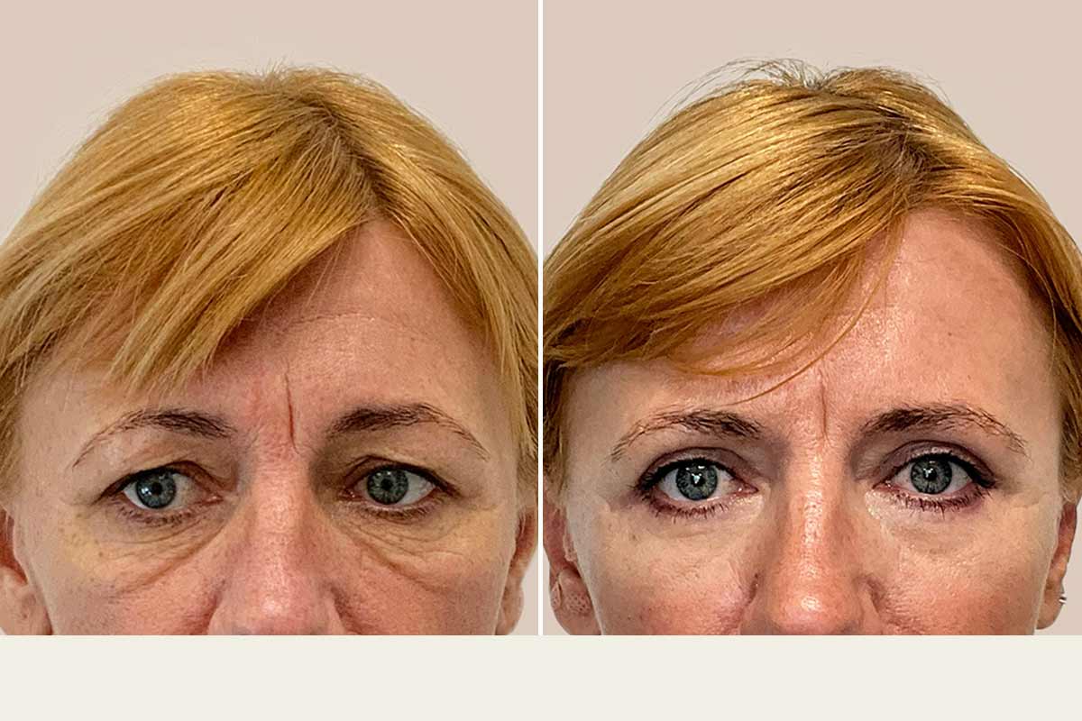 Øvre og nedre øjenlågsoperation