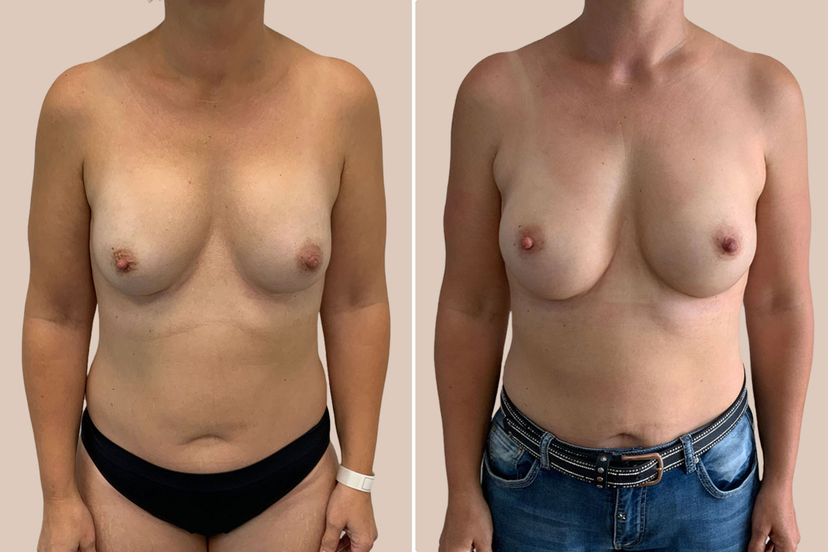 Udskiftning af implantater