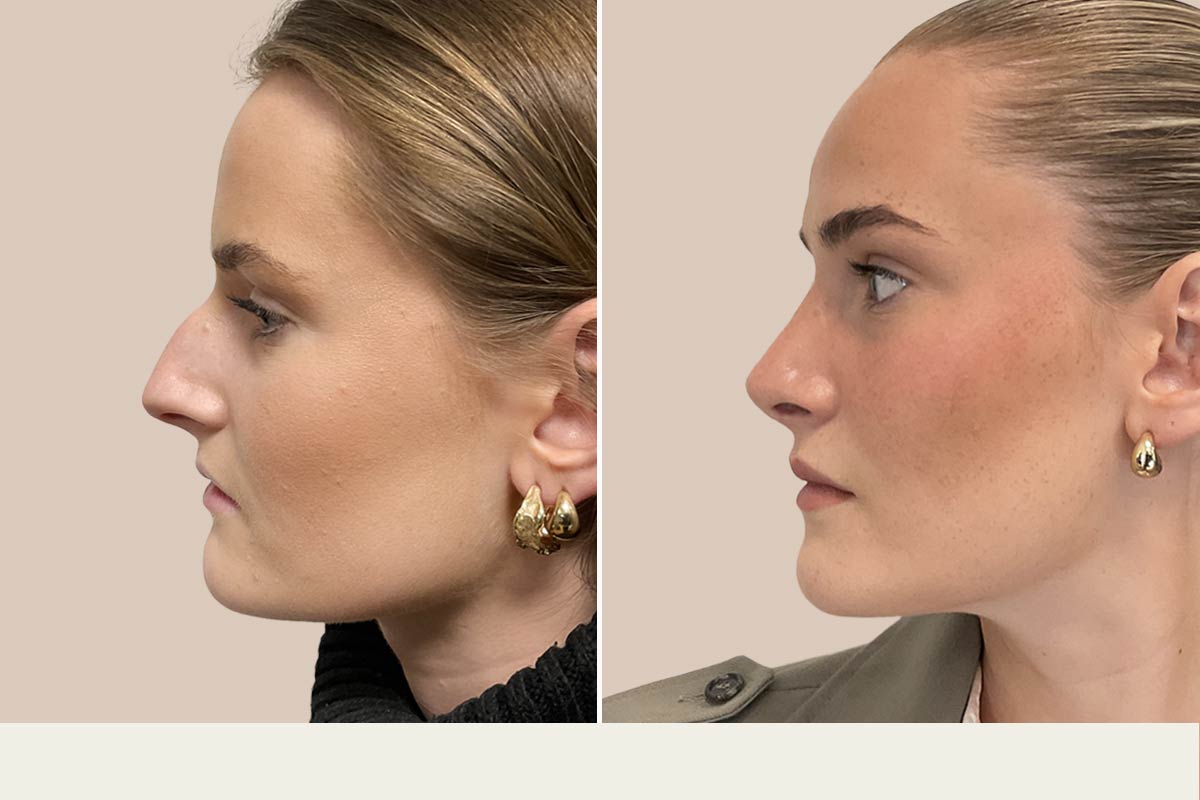 næseoperation før og efter