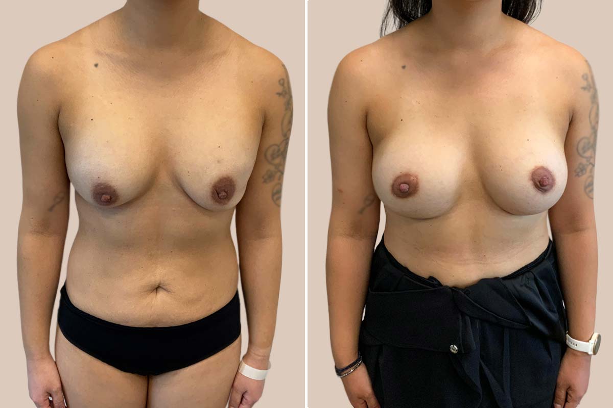 Udskiftning + lille løft: Mentor, runde 260/300 ml. til Motiva Ergonomix, full 400/425 ml.