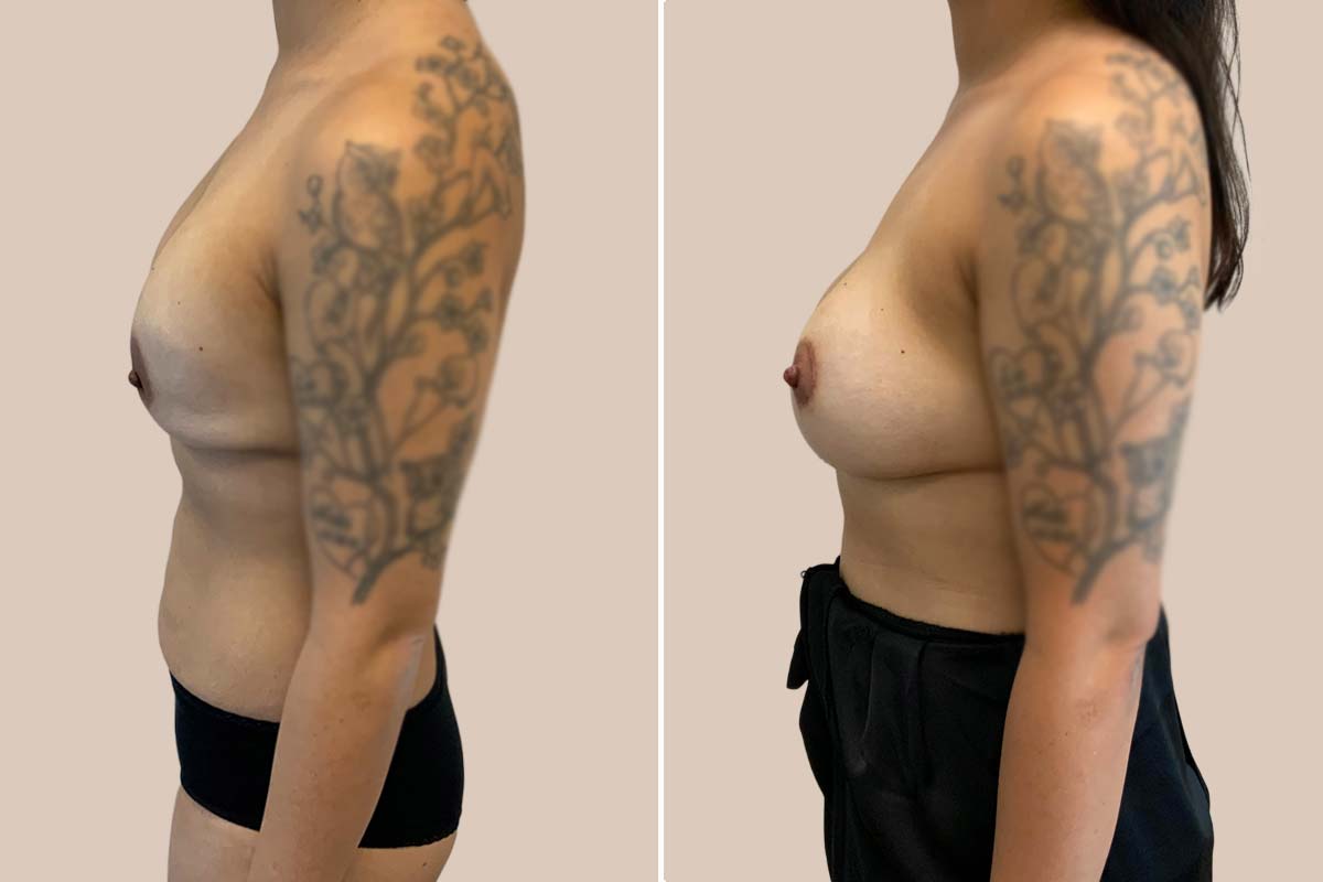 Udskiftning af implantater