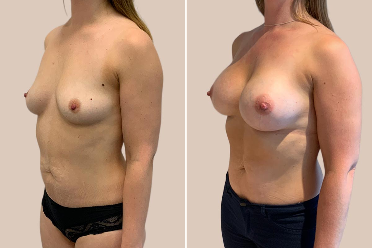 Brystforstørrelse før og efter