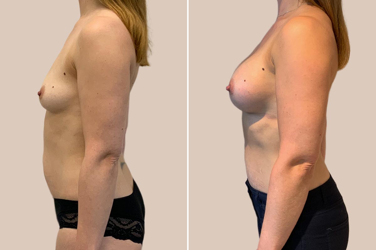 Brystforstørrelse før og efter