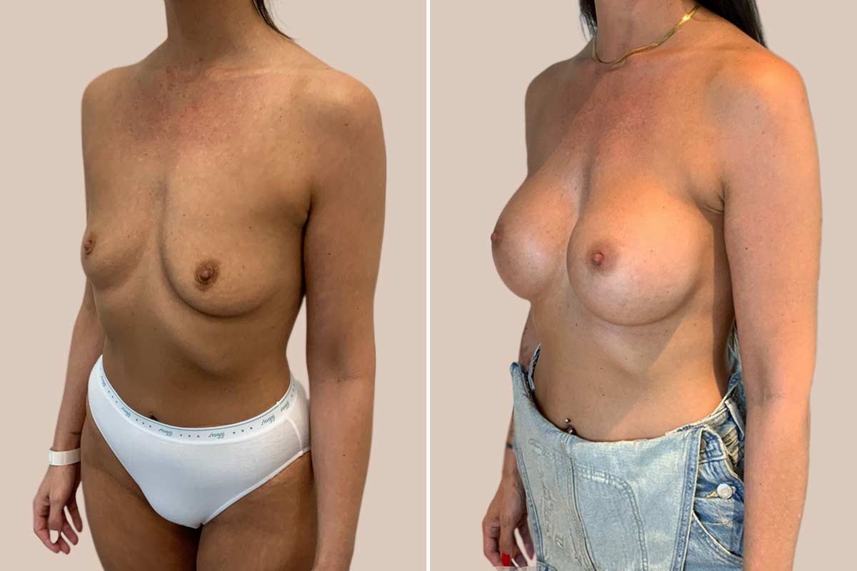 Brystforstørrelse før og efter