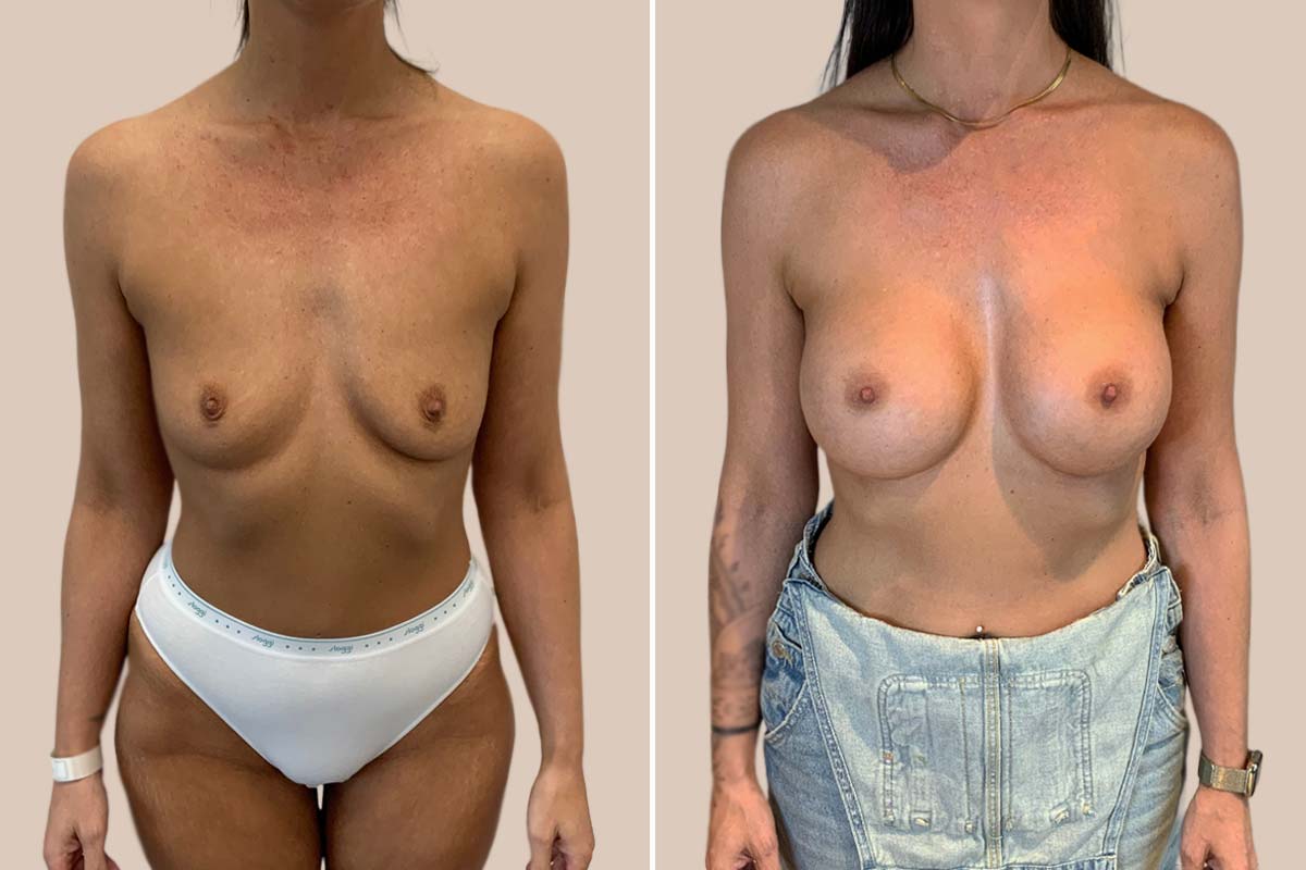 Brystforstørrelse før og efter