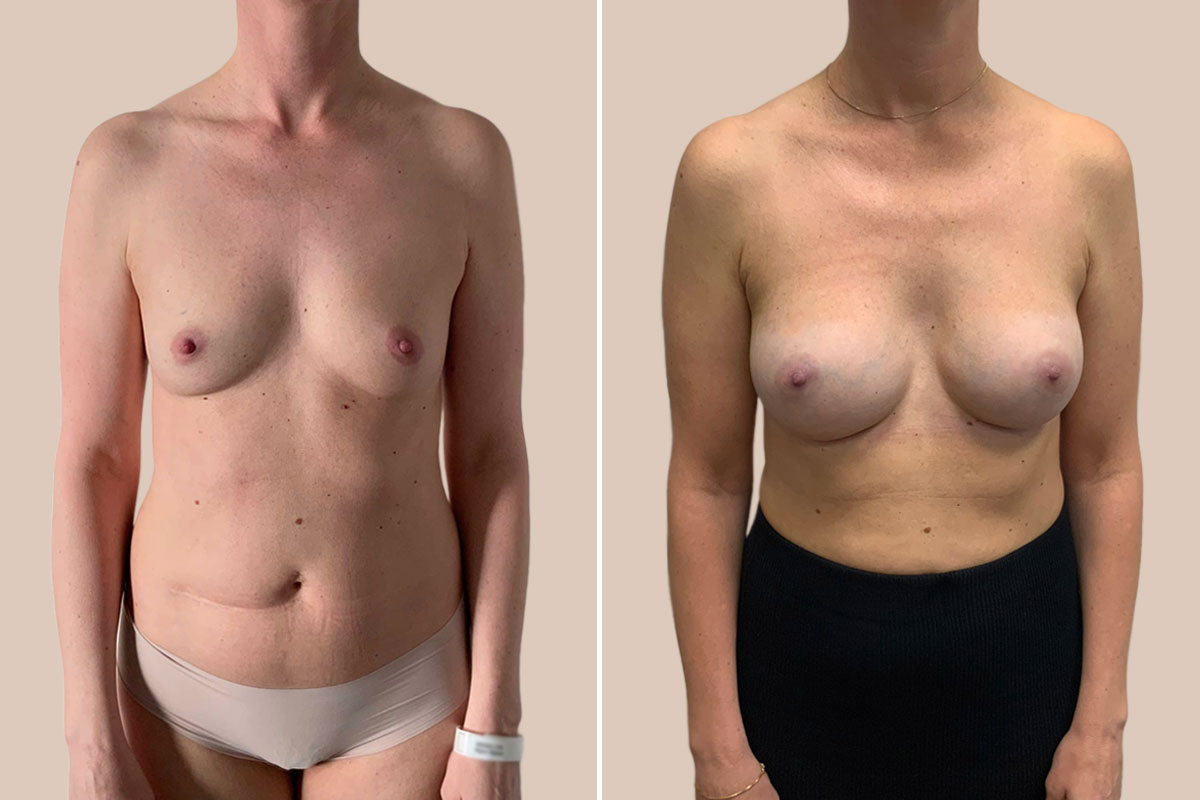 bfo før og efter billeder