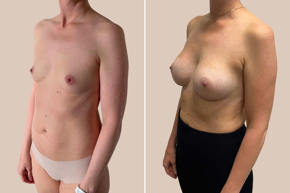 bfo før og efter billeder