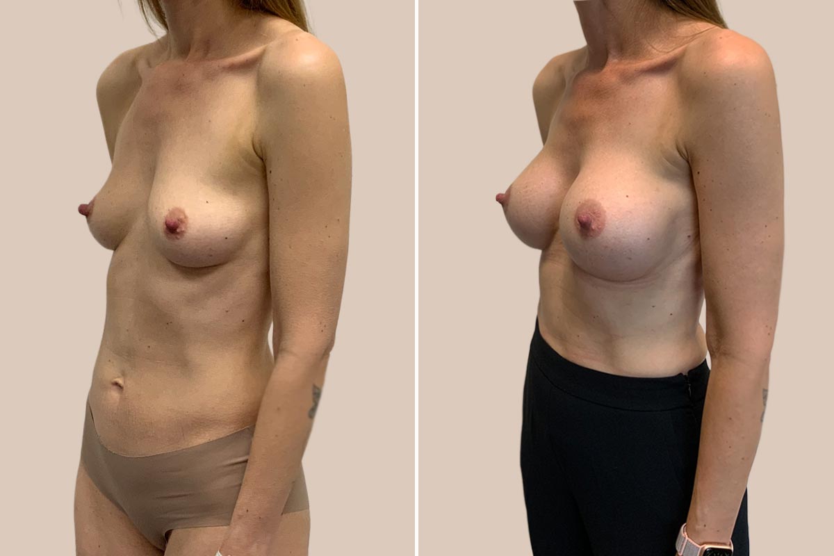 Brystforstørrelse før og efter