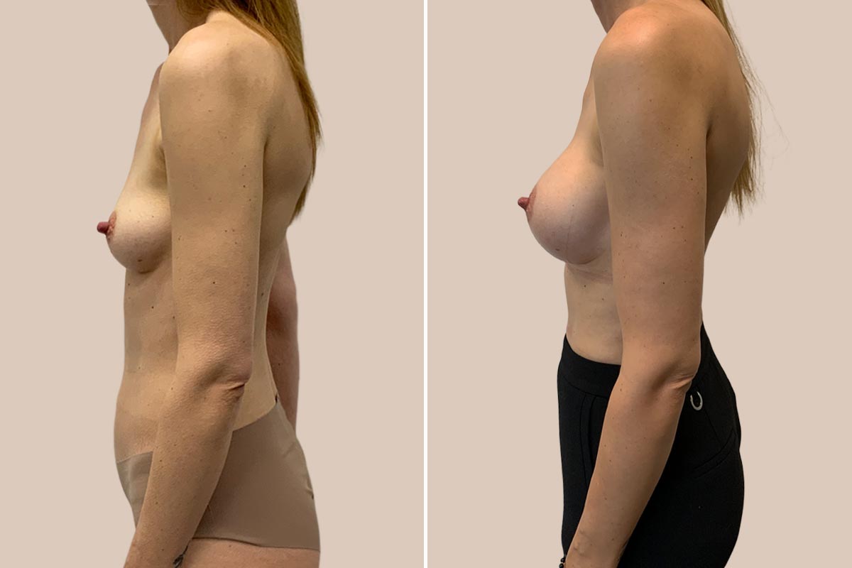 Brystforstørrelse før og efter