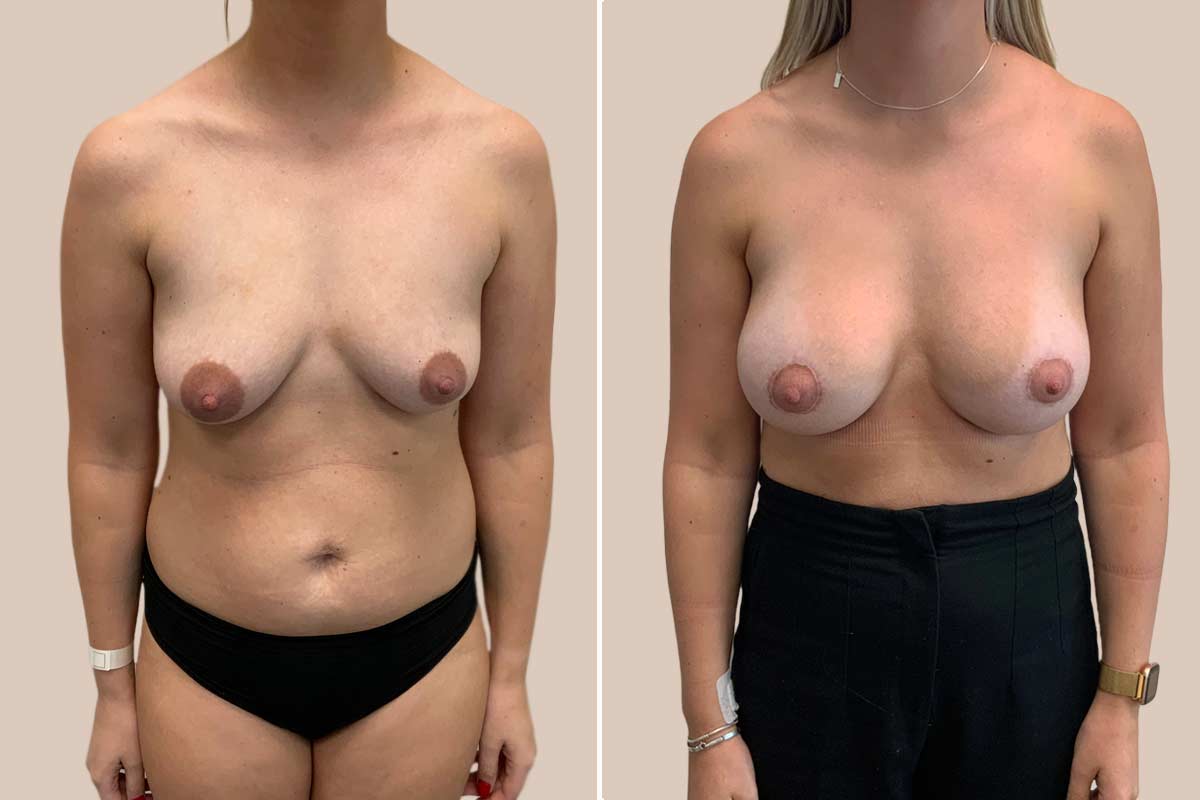 Brystforstørrelse og lille brystløft