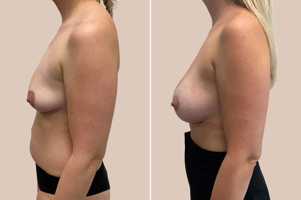 Brystforstørrelse og lille brystløft