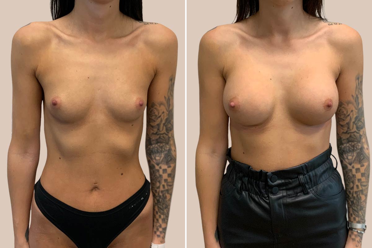 Brystforstørrelse før og efter