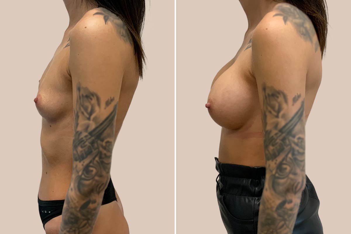 Brystforstørrelse før og efter